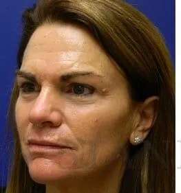 Skin Care Before & After Patient #1344