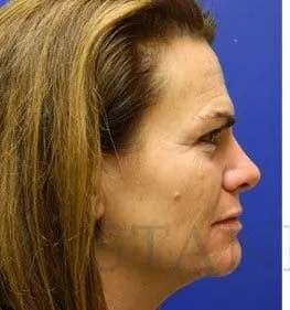 Skin Care Before & After Patient #1344