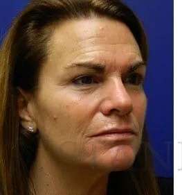 Skin Care Before & After Patient #1344
