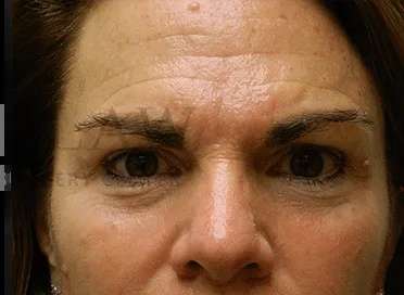 Wrinkles Before & After Patient #1347