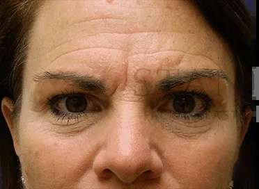 Wrinkles Before & After Patient #1347