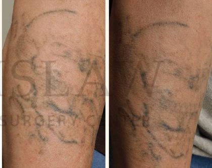Tattoo Removal Before & After Patient #1359