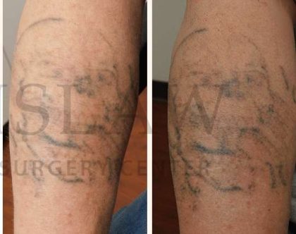 Tattoo Removal Before & After Patient #1359