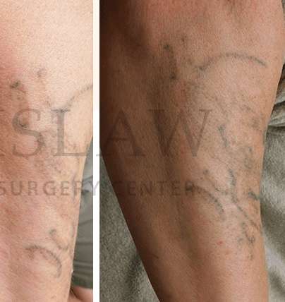 Tattoo Removal Before & After Patient #1359