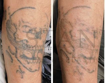 Tattoo Removal Before & After Patient #1359