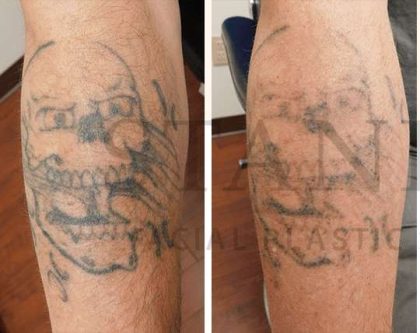 Tattoo Removal Before & After Patient #1359