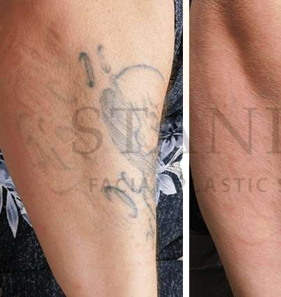 Tattoo Removal Before & After Patient #1359