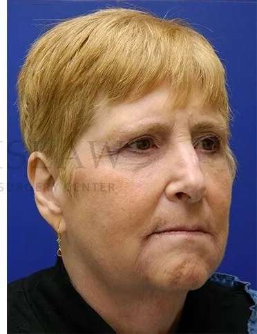 Tear Trough Filler Before & After Patient #1539