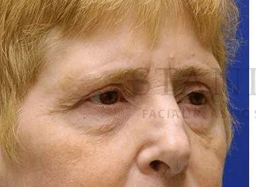 Tear Trough Filler Before & After Patient #1539