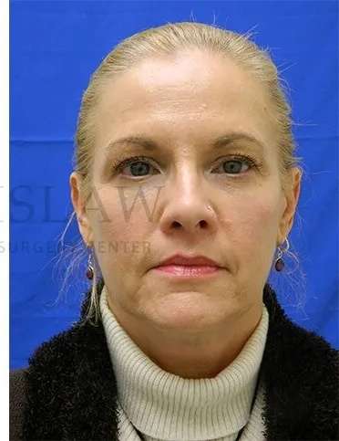 Tear Trough Filler Before & After Patient #1525