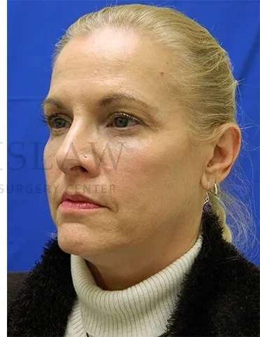 Tear Trough Filler Before & After Patient #1525