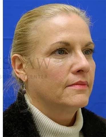 Tear Trough Filler Before & After Patient #1525