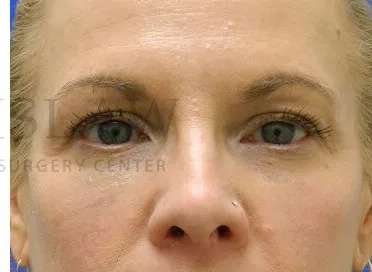 Tear Trough Filler Before & After Patient #1525