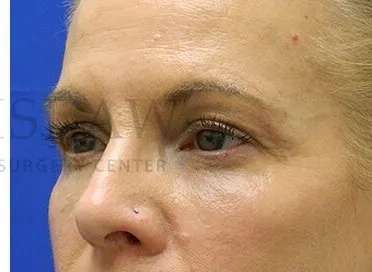 Tear Trough Filler Before & After Patient #1525