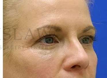 Tear Trough Filler Before & After Patient #1525
