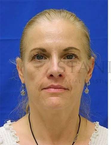 Tear Trough Filler Before & After Patient #1525