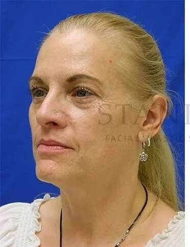 Tear Trough Filler Before & After Patient #1525