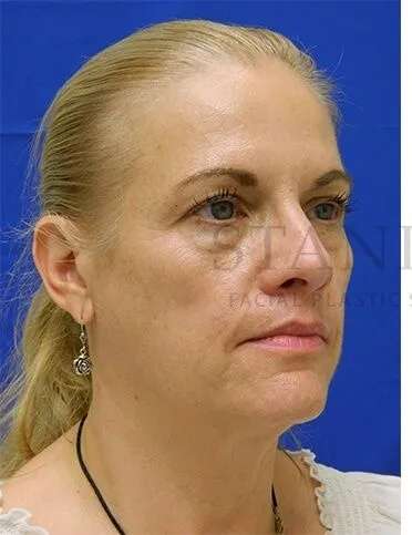 Tear Trough Filler Before & After Patient #1525