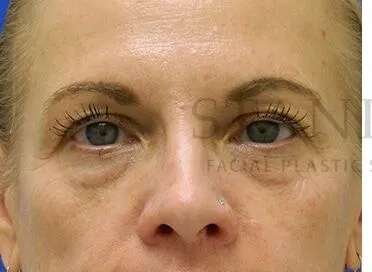 Tear Trough Filler Before & After Patient #1525