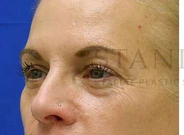 Tear Trough Filler Before & After Patient #1525
