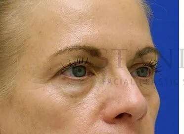 Tear Trough Filler Before & After Patient #1525