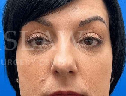 Tear Trough Filler Before & After Patient #1372