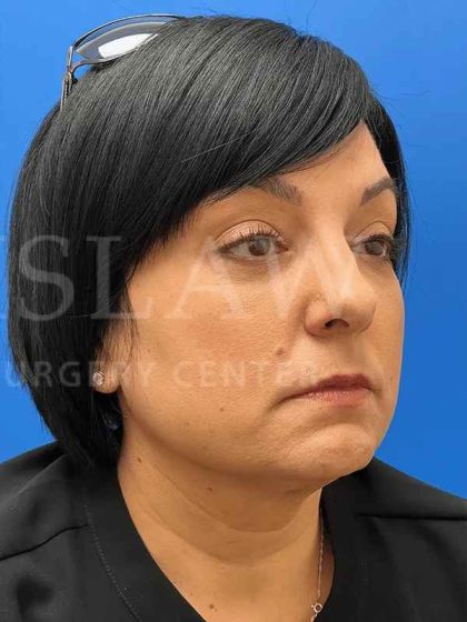 Tear Trough Filler Before & After Patient #1372