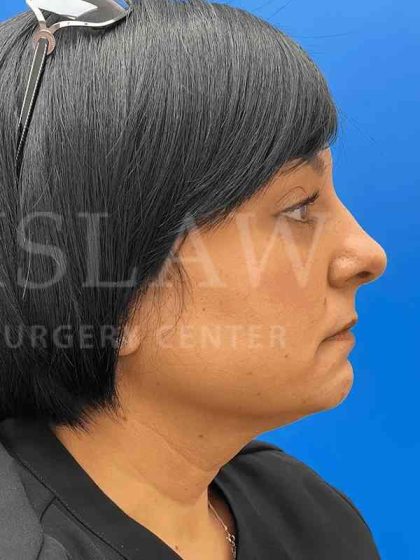 Tear Trough Filler Before & After Patient #1372