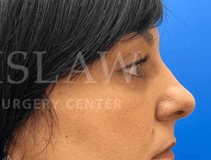 Tear Trough Filler Before & After Patient #1372