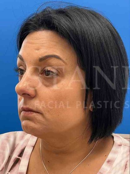 Tear Trough Filler Before & After Patient #1372