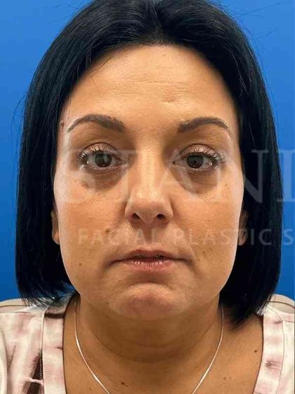 Tear Trough Filler Before & After Patient #1372