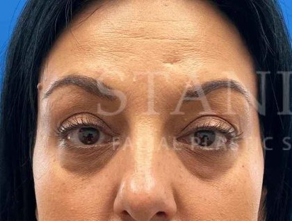 Tear Trough Filler Before & After Patient #1372