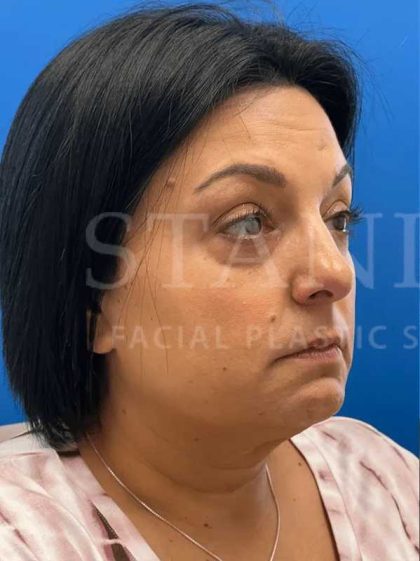 Tear Trough Filler Before & After Patient #1372