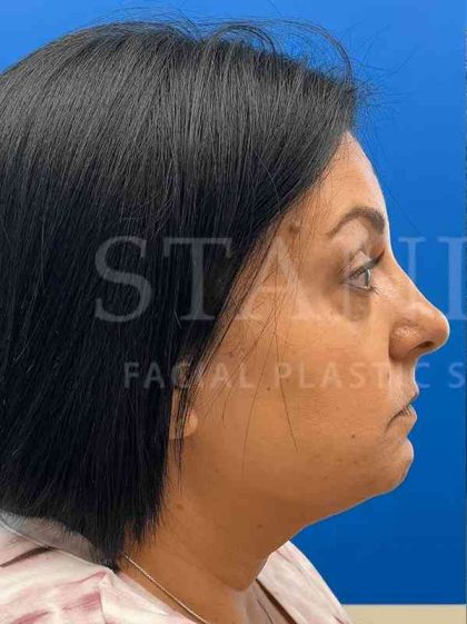 Tear Trough Filler Before & After Patient #1372