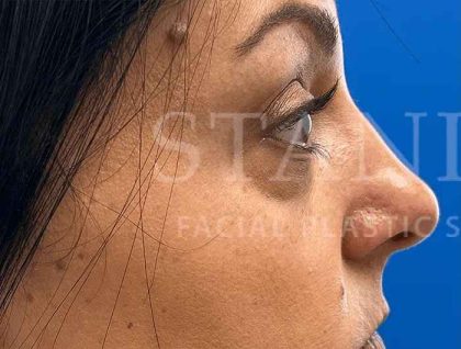Tear Trough Filler Before & After Patient #1372
