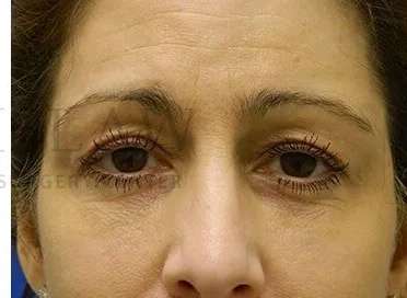 Tear Trough Filler Before & After Patient #1467