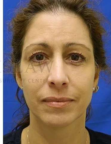 Tear Trough Filler Before & After Patient #1467