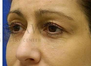 Tear Trough Filler Before & After Patient #1467