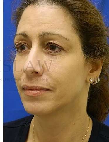 Tear Trough Filler Before & After Patient #1467