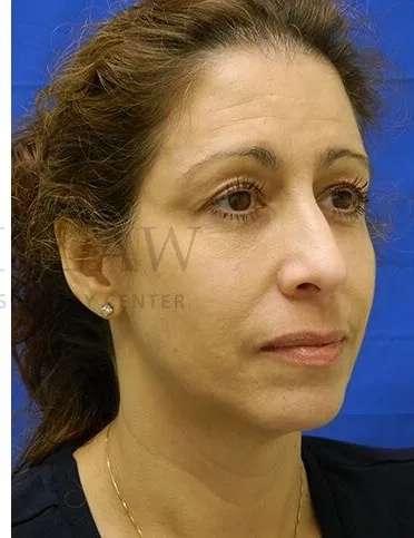 Tear Trough Filler Before & After Patient #1467
