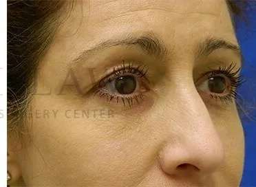 Tear Trough Filler Before & After Patient #1467
