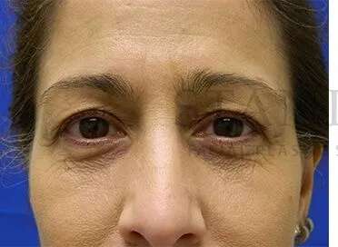 Tear Trough Filler Before & After Patient #1467