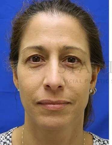 Tear Trough Filler Before & After Patient #1467