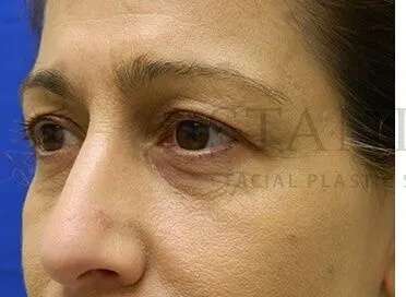 Tear Trough Filler Before & After Patient #1467