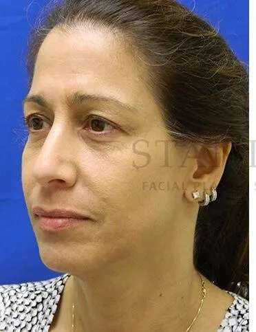 Tear Trough Filler Before & After Patient #1467
