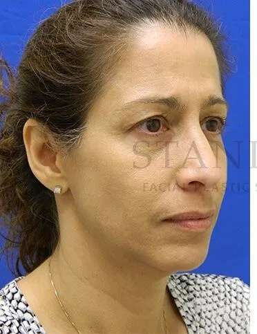 Tear Trough Filler Before & After Patient #1467