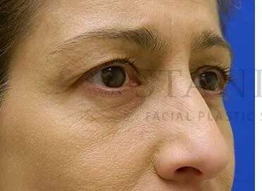 Tear Trough Filler Before & After Patient #1467