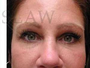 Tear Trough Filler Before & After Patient #1454