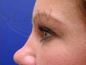 Tear Trough Filler Before & After Patient #1454