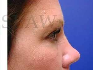 Tear Trough Filler Before & After Patient #1454